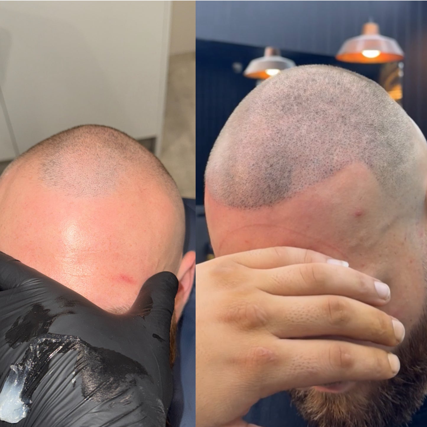 Scalp Micro Pigmentation